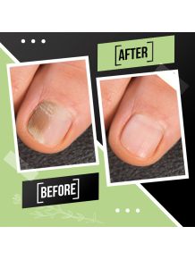 Tratamiento Reparador Integral de Uñas: Fortalecedor Quimio y/o Antihongos - Fungusless (Simon & Tom)