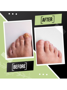 Tratamiento Reparador Integral de Uñas: Fortalecedor Quimio y/o Antihongos - Fungusless (Simon & Tom)